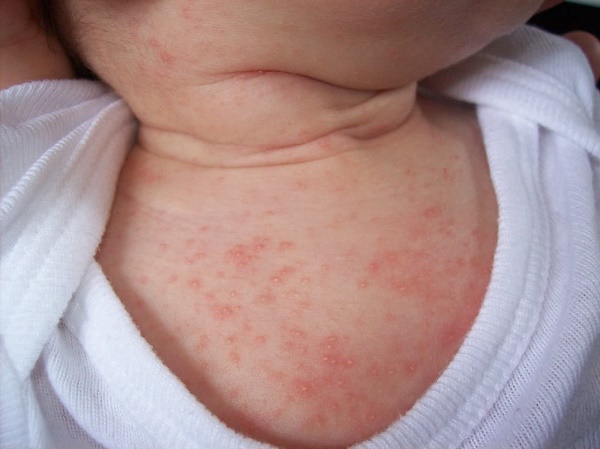 baby-heat-rash
