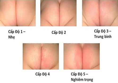 dau-hieu-benh-ham-ta-o-tre-em