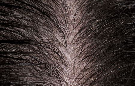 Cách trị gàu mùa Đông hiệu quả tại nhà và giúp tóc thơm hương lâu nhất