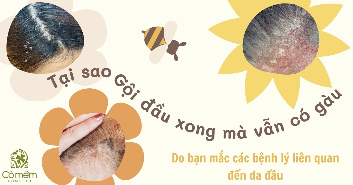 Tại sao gội đầu xong mà vẫn có gàu