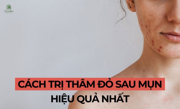 cách trị thâm đỏ sau mụn