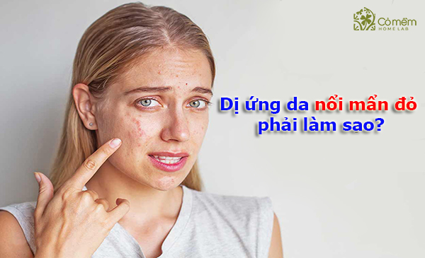 Dấu hiệu và cách điều trị da mặt bị dị ứng nổi sần ngứa